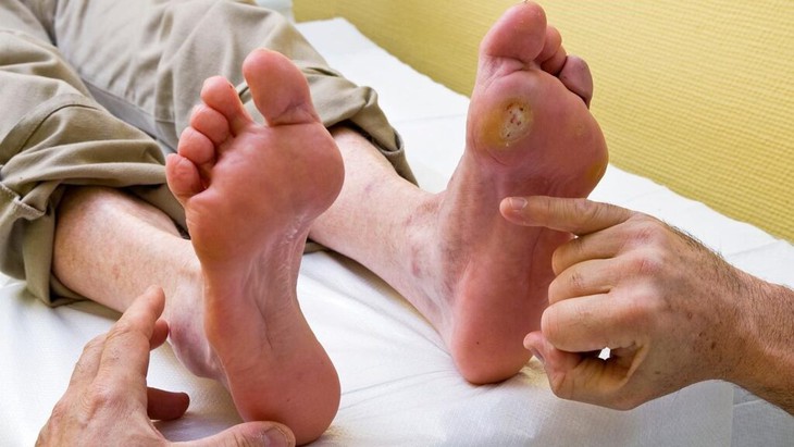 Tổn thương bàn chân ở người tiểu đường cần phát hiện sớm- Ảnh 1.