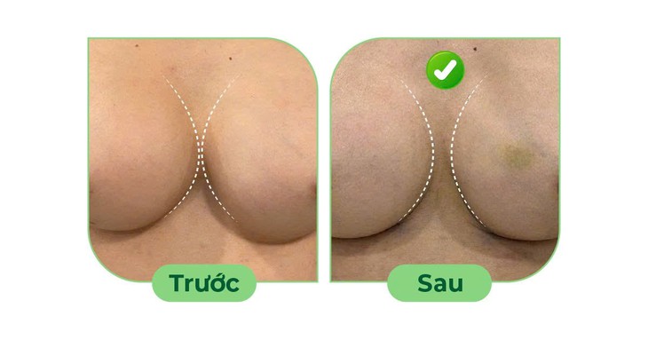 Điều trị ngực thông khe sau nâng ngực- Ảnh 1.