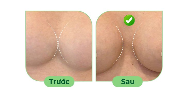 Điều trị ngực thông khe sau nâng ngực- Ảnh 2.