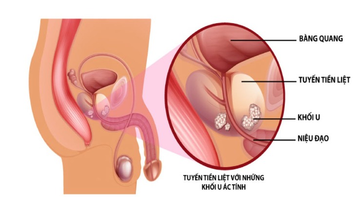 Ung thư tiền liệt tuyến có thể chữa khỏi nếu phát hiện sớm và điều trị kịp thời- Ảnh 2. Ung thư tiền liệt tuyến có thể chữa khỏi nếu phát hiện sớm và điều trị kịp thời- Ảnh 2.