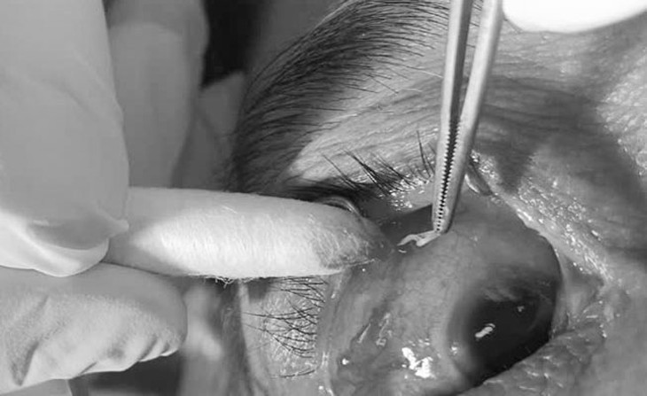 Suýt ngất khi phát hiện giun đũa dài 4cm nằm trong mắt- Ảnh 1.