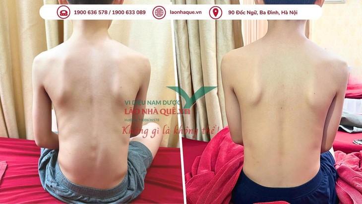 Phương pháp 'Khai thông cột sống' điều trị đau do thoái hóa khớp tại Lão Nhà Quê- Ảnh 3. Phương pháp 'Khai thông cột sống' điều trị đau do thoái hóa khớp tại Lão Nhà Quê- Ảnh 3.