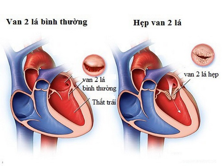Khó thở cảnh giác với bệnh hẹp van hai lá- Ảnh 1.