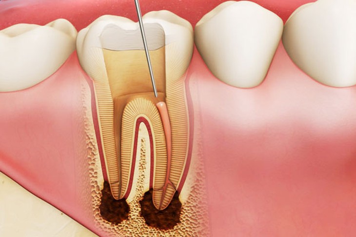 Điều trị lấy tuỷ buồng cho răng viêm tuỷ có tổn thương quanh chóp: Cơ hội giữ lại tuỷ sống cho răng- Ảnh 1.