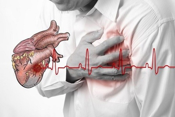 Biến chứng nguy hiểm của nhồi máu cơ tim- Ảnh 1. Biến chứng nguy hiểm của nhồi máu cơ tim- Ảnh 1.