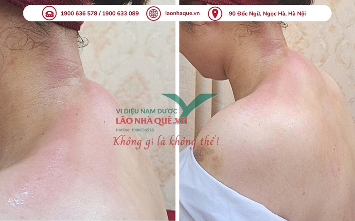 Đau vai gáy dai dẳng - cảnh báo thoái hóa đốt sống cổ từ thói quen xấu