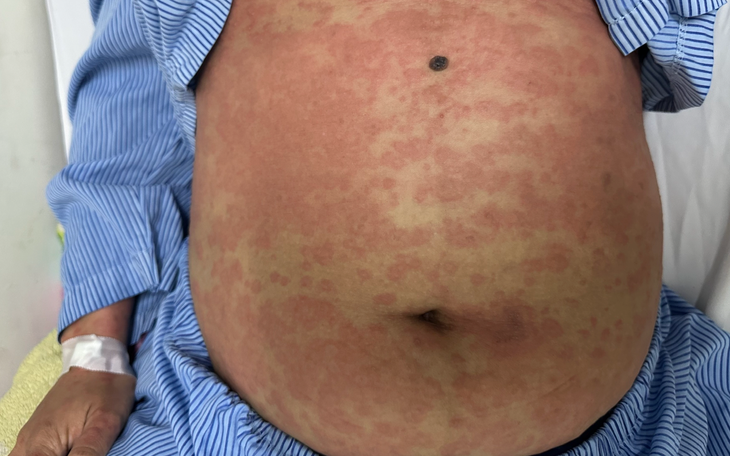 Một phụ nữ nguy kịch sau khi dùng thuốc giảm cân thải độc, collagen không rõ nguồn gốc