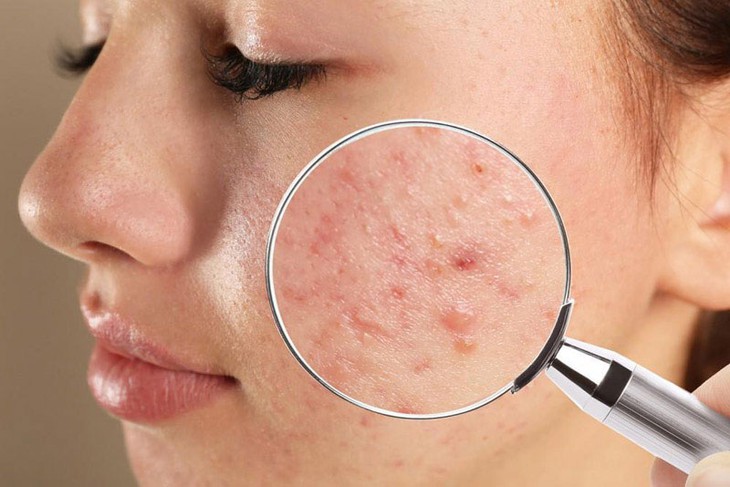 Bôi kem đánh răng có giúp điều trị mụn trứng cá?- Ảnh 2.