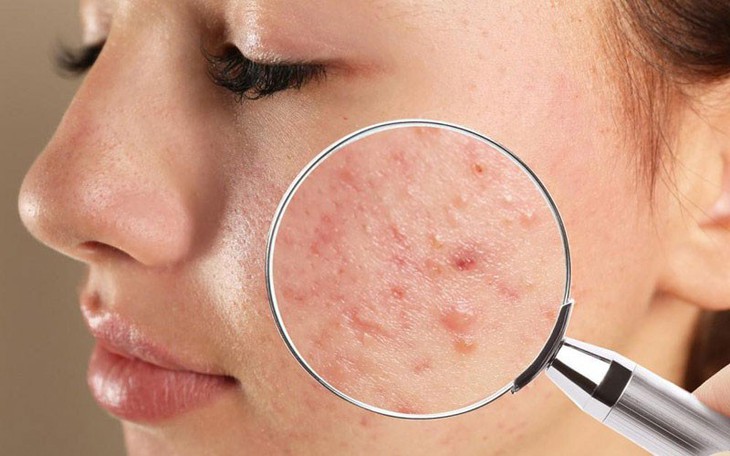 Bôi kem đánh răng có giúp điều trị mụn trứng cá?