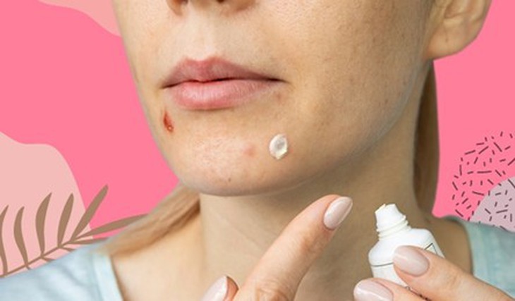 Bôi kem đánh răng có giúp điều trị mụn trứng cá?- Ảnh 3.