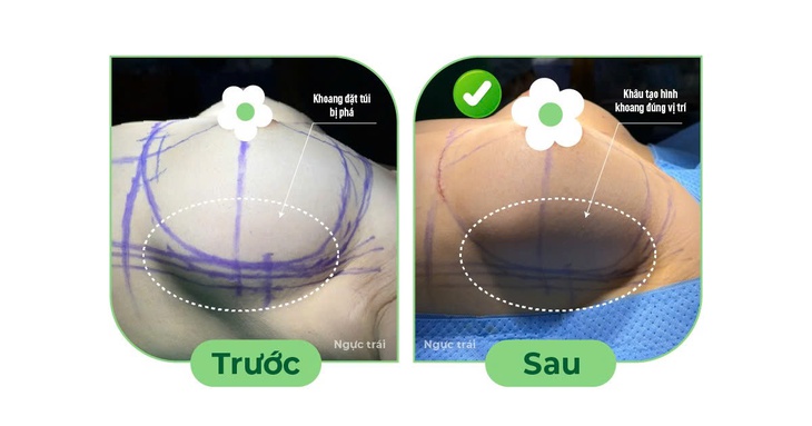 Điều trị ngực cứng sau nâng ngực- Ảnh 1.
