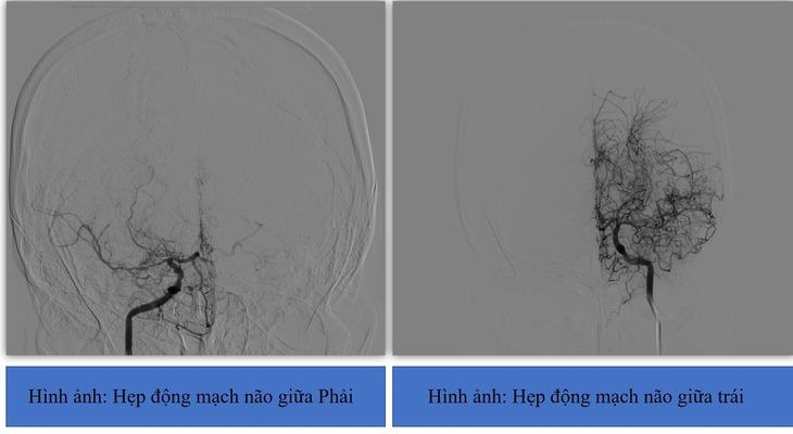 Đau đầu, khó nói, người phụ nữ bị nhồi máu não do căn bệnh hiếm gặp- Ảnh 1. Đau đầu, khó nói, người phụ nữ bị nhồi máu não do căn bệnh hiếm gặp- Ảnh 1.