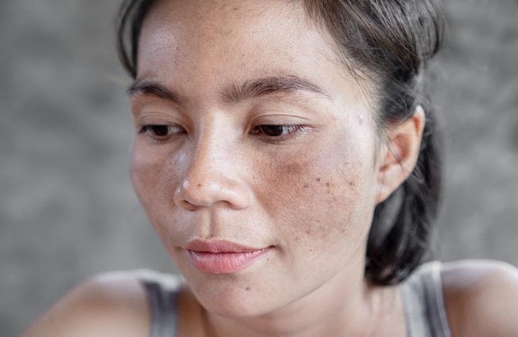 7 vấn đề về da mùa hè có thể ngăn ngừa- Ảnh 2.