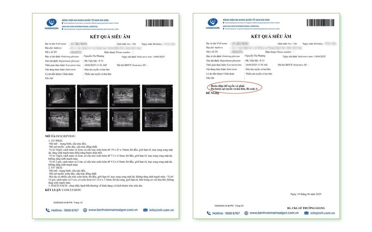 Bóc u vú kết hợp đặt túi ngực- Ảnh 1.