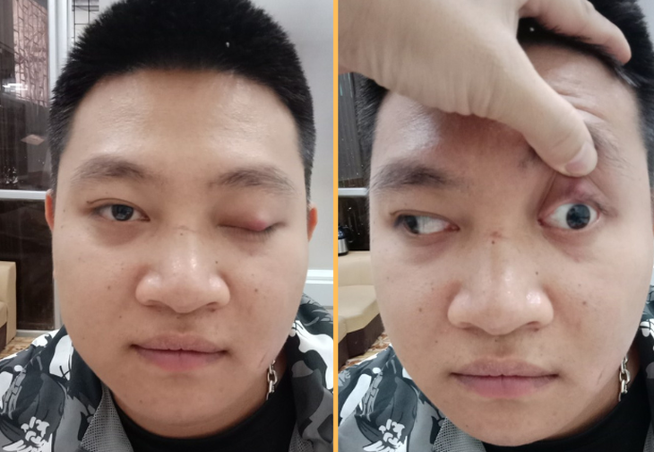 Phương pháp Đông y trong điều trị sụp mí mắt do liệt dây thần kinh số 3- Ảnh 2.