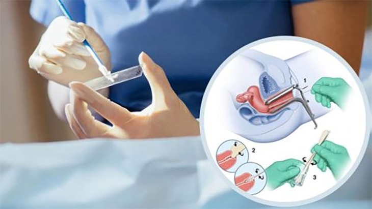 Cách tốt nhất để phát hiện sớm ung thư cổ tử cung- Ảnh 1.