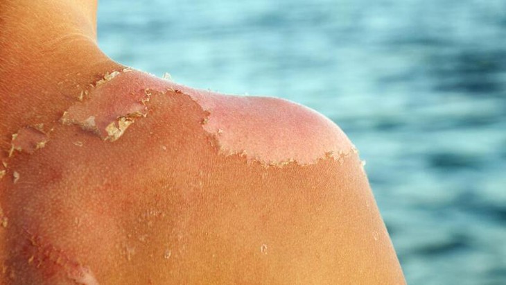 Chữa viêm da do cháy nắng, bỏng nắng bằng Đông y- Ảnh 1.