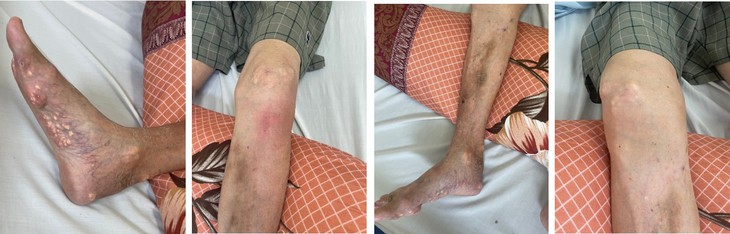 Tự ý mua thuốc của thầy lang để chữa gout, bệnh nhân bị suy tuyến thượng thận- Ảnh 2. Tự ý mua thuốc của thầy lang để chữa gout, bệnh nhân bị suy tuyến thượng thận- Ảnh 2.