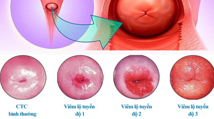 Cảnh báo biến chứng nguy hiểm của viêm lộ tuyến cổ tử cung- Ảnh 2. Cảnh báo biến chứng nguy hiểm của viêm lộ tuyến cổ tử cung- Ảnh 2.