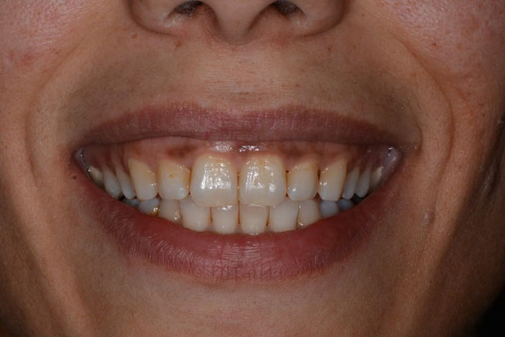Muốn cười đẹp đừng bỏ quên nướu: Chăm đúng cách, nướu sẽ hồng!- Ảnh 1.