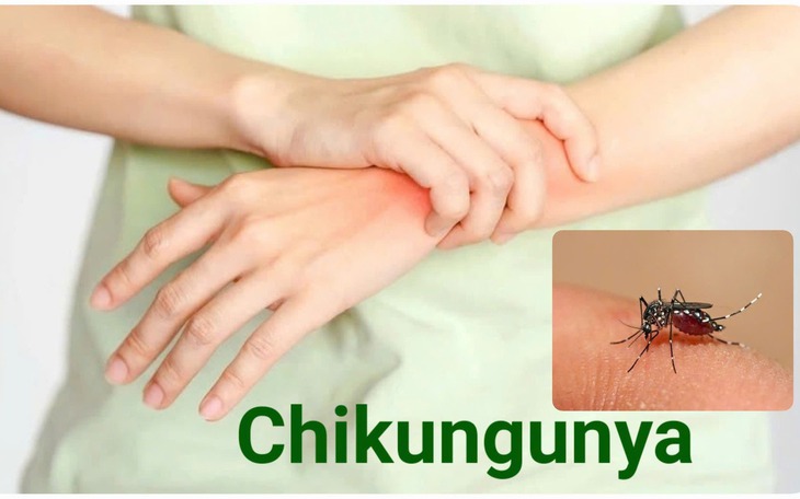 Bệnh Chikungunya: Nguyên nhân, triệu chứng, cách điều trị và phòng bệnh