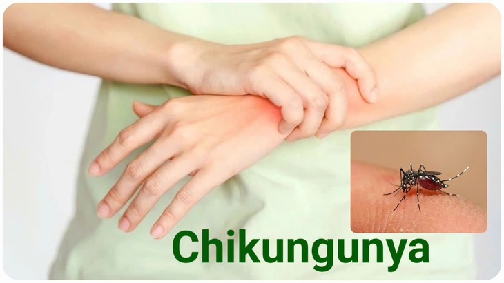 Bệnh Chikungunya: Nguyên nhân, triệu chứng, cách điều trị và phòng bệnh- Ảnh 3.