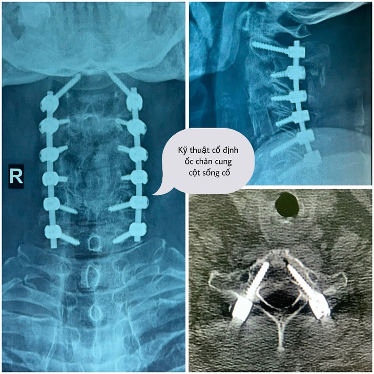 Phẫu thuật đặt ốc chân cung cố định cột sống cổ cứu nam thanh niên bị liệt tứ chi sau tai nạn- Ảnh 2. Phẫu thuật đặt ốc chân cung cố định cột sống cổ cứu nam thanh niên bị liệt tứ chi sau tai nạn- Ảnh 2.
