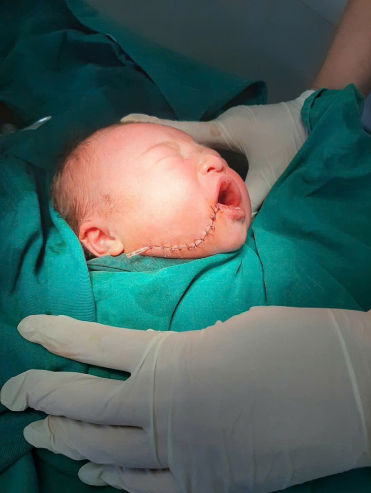 Những nỗ lực chăm sóc bà mẹ, trẻ em ở Lũng Cú và câu chuyện lay động cứu sống bé sơ sinh bị rạch một vết sâu vào má- Ảnh 2.