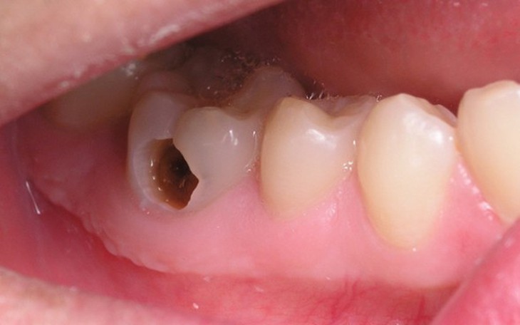 Nhận biết và đề phòng sâu răng ở trẻ