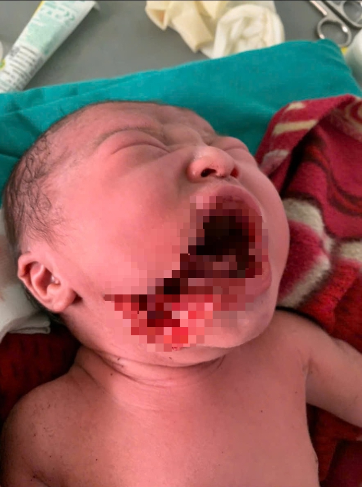 Những nỗ lực chăm sóc bà mẹ, trẻ em ở Lũng Cú và câu chuyện lay động cứu sống bé sơ sinh bị rạch một vết sâu vào má- Ảnh 1.