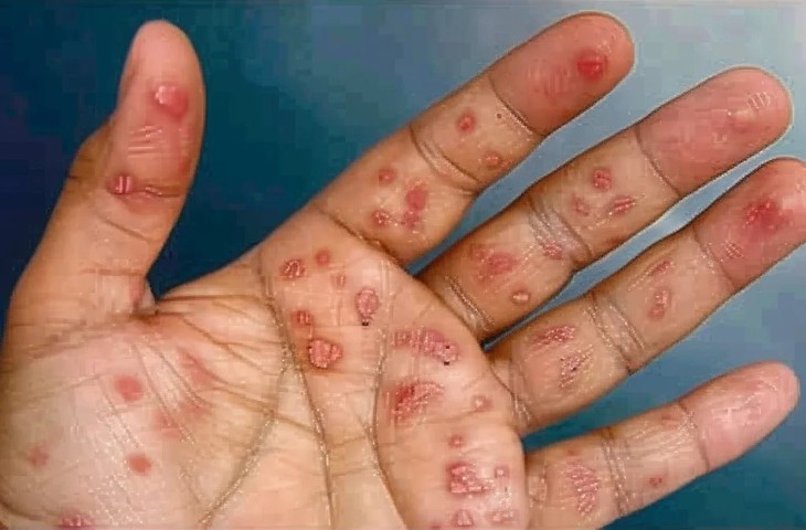 Xét nghiệm chẩn đoán và điều trị bệnh giang mai- Ảnh 1.