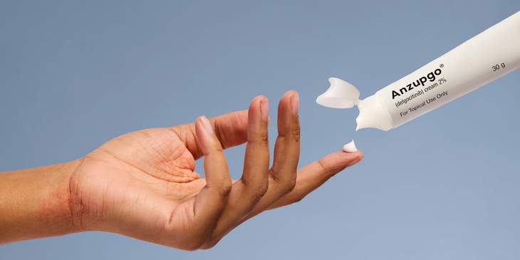 FDA Approves Anzupgo for Chronic Hand Eczema - MPR