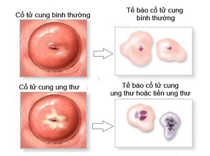 Các xét nghiệm cần thiết giúp sàng lọc ung thư cổ tử cung- Ảnh 2. Các xét nghiệm cần thiết giúp sàng lọc ung thư cổ tử cung- Ảnh 2.