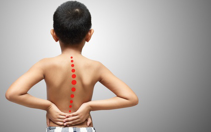 Vì sao cong vẹo cột sống thường gặp ở tuổi dậy thì?- Ảnh 3.