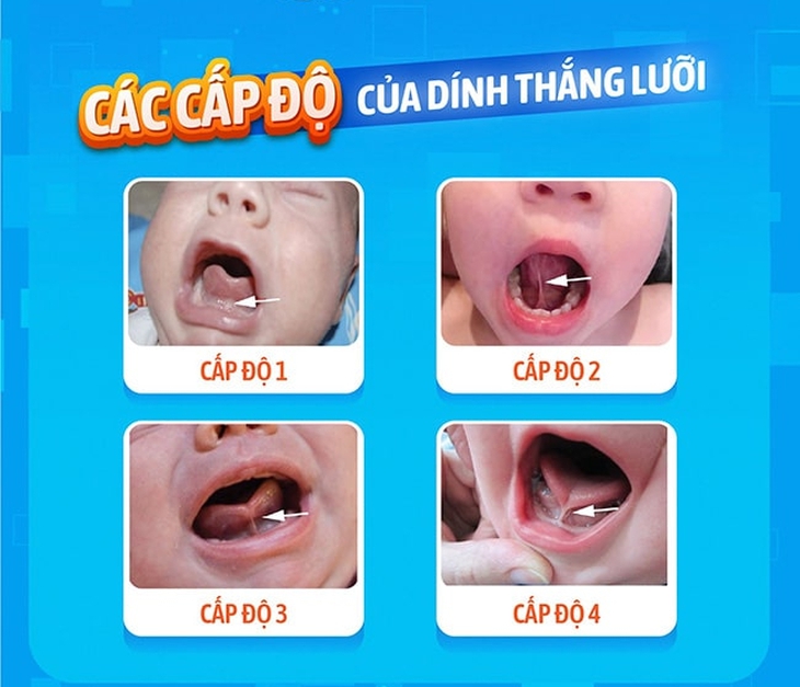 https://benhviennhitrunguong.gov.vn/wp-content/uploads/2025/08/Dinh-thang-luoi-Nhan-biet-som-can-thiep-kip-thoi-2.jpg