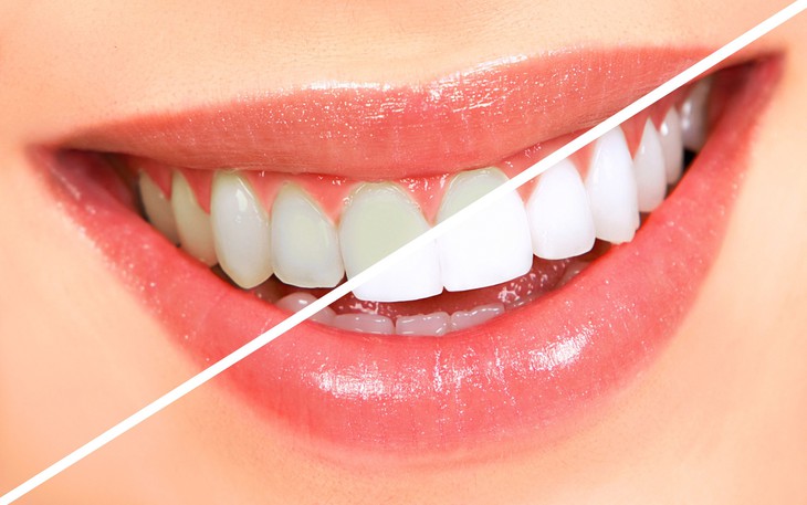 Tẩy trắng răng có hại không?- Ảnh 1.