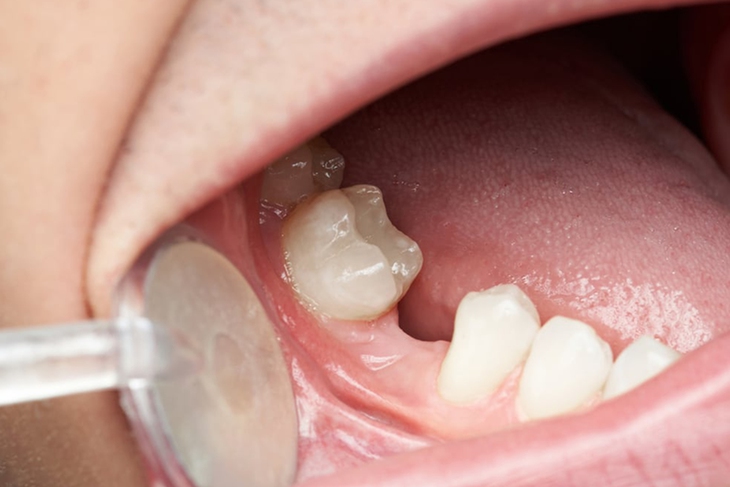 Mất răng số 7 hàm dưới có sao không? Giải pháp khắc phục hiệu quả- Ảnh 1.