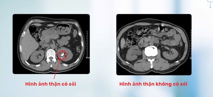 Tán sỏi qua da cho người đàn ông bị dị tật thận đôi cực hiếm- Ảnh 1.