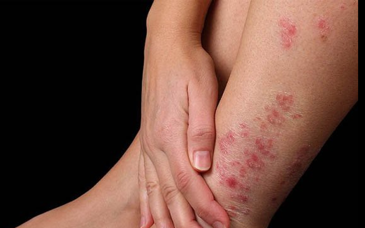 Phát hiện sớm bệnh ngoài da mùa mưa lũ