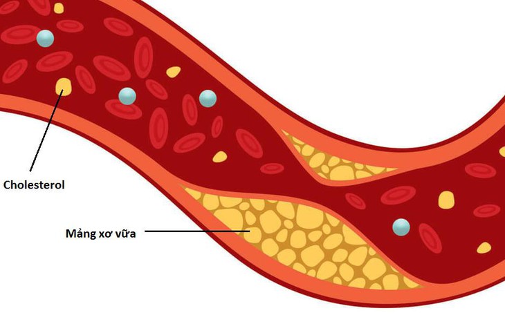 9 cách tự nhiên giúp giảm cholesterol xấu, bảo vệ tim mạch