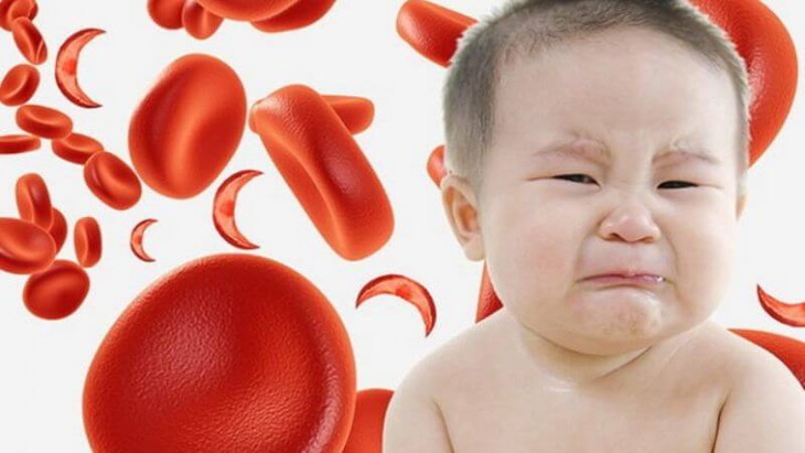 5 triệu chứng cảnh báo thiếu sắt ở trẻ em, bổ sung như thế nào cho đúng?- Ảnh 1.