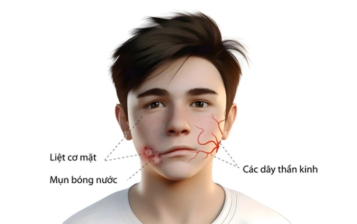 Liệt mặt do zona có biểu hiện như thế nào?- Ảnh 1.