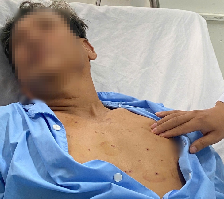 Người đàn ông sốc tim, nhồi máu cơ tim do lạm dụng chích lể
tại nhà- Ảnh 2.