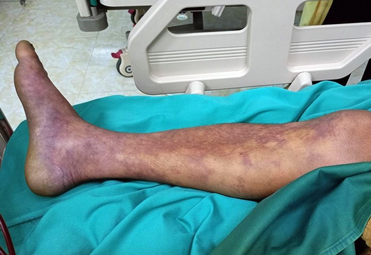 Ca nhiễm liên cầu lợn tăng ở một số nơi, cần biết các khuyến cáo phòng bệnh của Bộ Y tế- Ảnh 1.