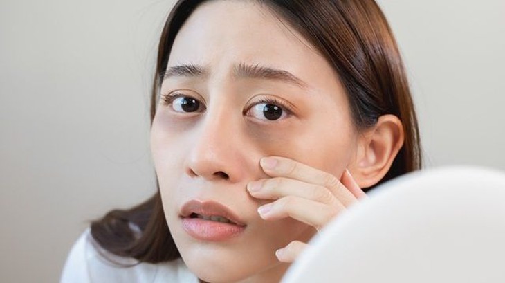 Quầng thâm dưới mắt: Nguyên nhân và cách điều trị