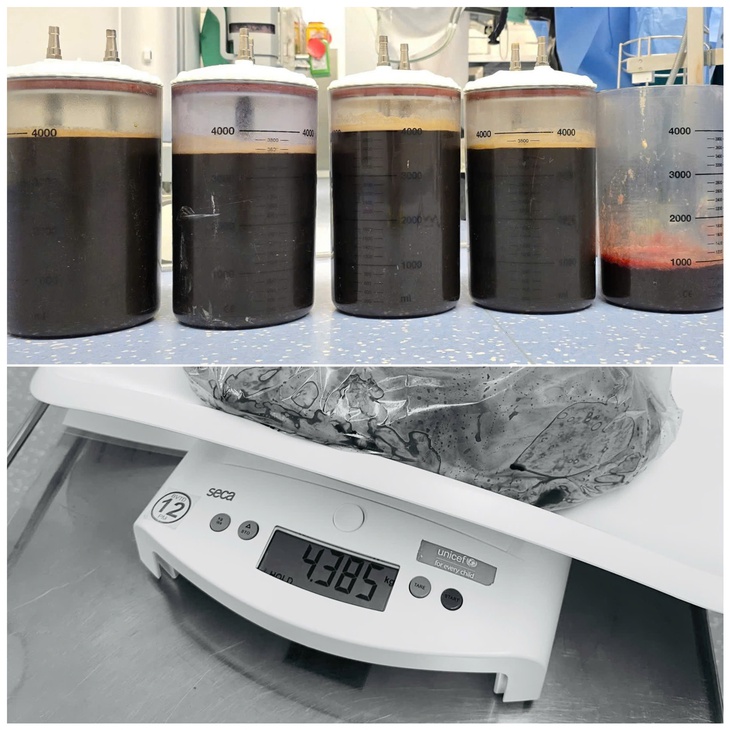 Người phụ nữ 34 tuổi ở TPHCM mang khối u buồng trứng nặng 20,5kg- Ảnh 2.