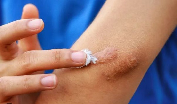 Bộ Y tế đình chỉ, thu hồi toàn quốc, yêu cầu tiêu huỷ 1 loại gel 'ngừa sẹo' do vi phạm 3 lỗi- Ảnh 1.