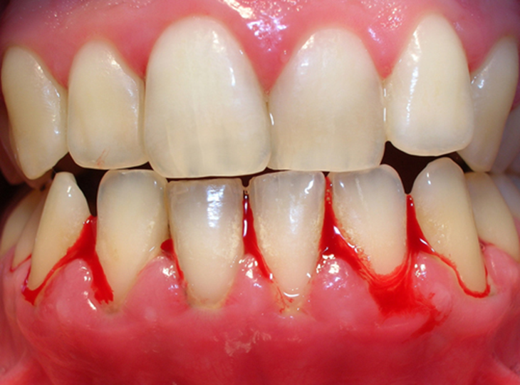 Hành trình 'giải cứu' nướu viêm: Từ thảo dược tự nhiên đến liệu pháp chuyên sâu- Ảnh 1. Hành trình 'giải cứu' nướu viêm: Từ thảo dược tự nhiên đến liệu pháp chuyên sâu- Ảnh 1.