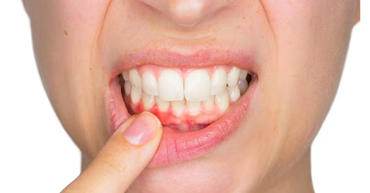 5 sai lầm 'tai hại' khi đánh răng, 'hủy hoại' nướu (lợi) mỗi ngày- Ảnh 2. 5 sai lầm 'tai hại' khi đánh răng, 'hủy hoại' nướu (lợi) mỗi ngày- Ảnh 2.