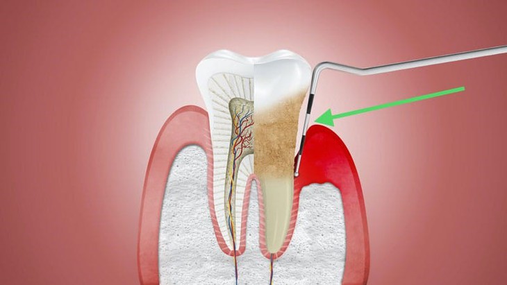 Thói quen chăm sóc răng miệng có hại cho răng và nướu (lợi)- Ảnh 3.